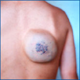 Fleboangioma de espalda 