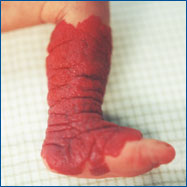Angioma tuberoso de pierna