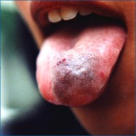 Angioma cavernoso de lengua