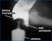 Defecograma