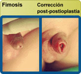 Fimosis - Corrección post-postioplástica