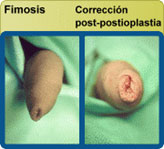 Fimosis - Corrección post-postioplástica