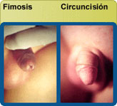 Fimosis - Circuncisión