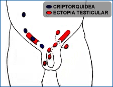 Ubicación de testículos no descendidos